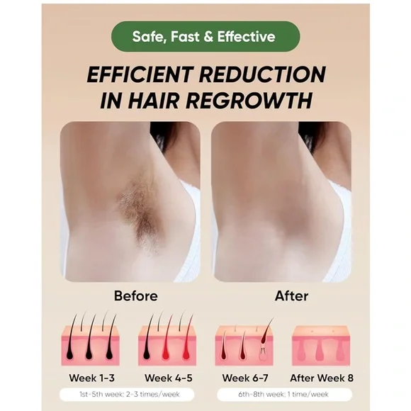 Xsoul Handheld IPL Hair Removal Device At Home Laser Permanent Hair Removal - Picture 10 of 14